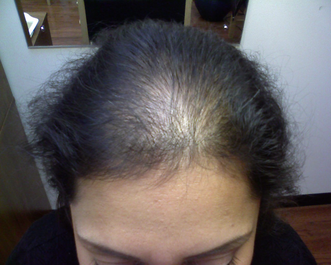 Alopecia Hair Loss on Link Between Iron Deficiency   Female Hair Loss   Dr  Gregory Chernoff